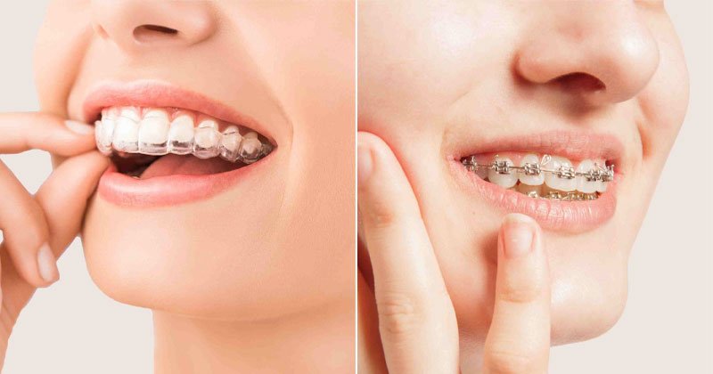 Clear Aligners Treatment