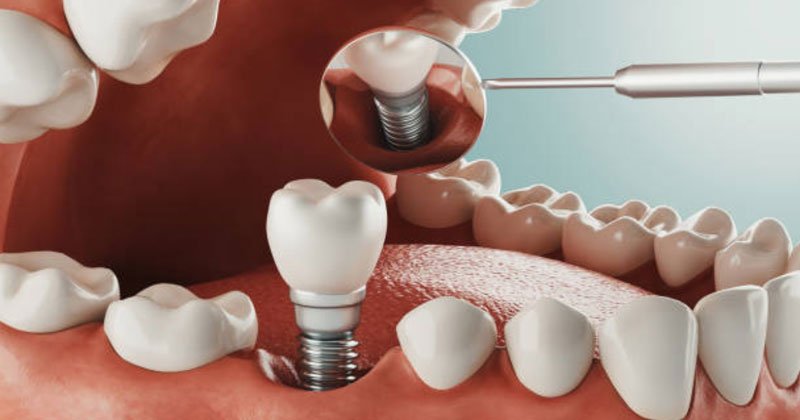 Dental Implants