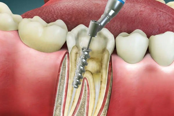 Root Canal Treatment